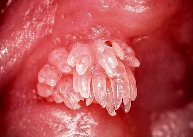 Human papilloma virus kezelese Gastric cancer brca